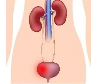 The reasons for the development of cystitis in women