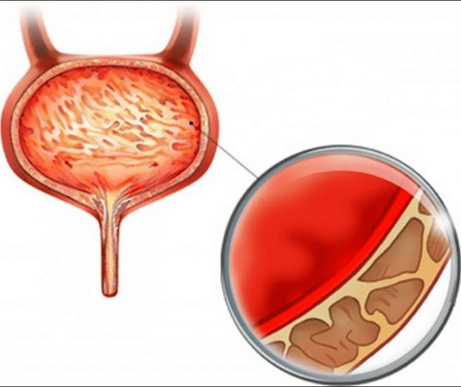 Cystitis inflammation